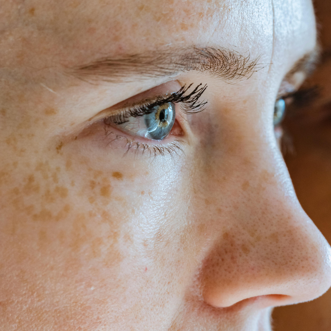 Summer is starting. We need to talk about pigmentation, not SPF.